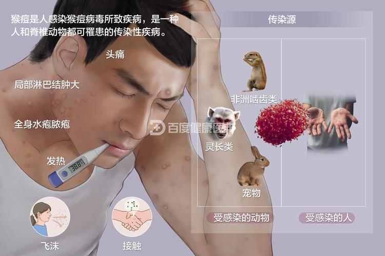 猴痘疫情是什么症状？猴痘疫情是什么症状?？