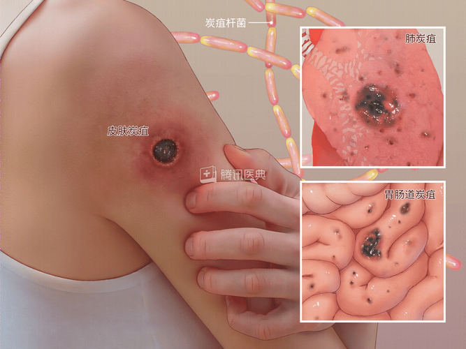 辽宁炭疽病疫情?辽宁肺炎疫情最新消息29人死亡?-第2张图片-柯迪百科 辽宁炭疽病疫情?辽宁肺炎疫情最新消息29人死亡?-第2张图片-柯迪百科