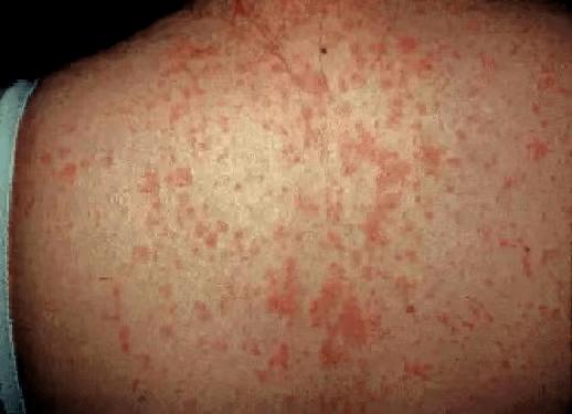 疫情症状表现有哪些?疫情症状症?-第2张图片-柯迪百科 疫情症状表现有哪些?疫情症状症?-第2张图片-柯迪百科